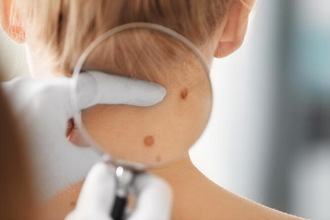 Genitalbereich hautkrebsscreening
