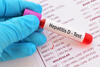 Blutprobe mit Aufschrift für Hepatitis-D-Test
