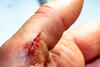Offene Wunde am Finger