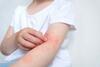Kind kratzt sich seine von Neurodermitis betroffenen Armbeugen