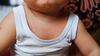Close-uo vom Hals eines Babys im Unterhemd mit Hitzepickeln